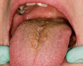 Plakett på tungen med duodenitt (betennelse i slimhinnen i tolvfingertarmen)