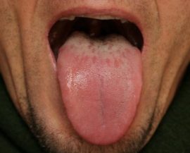 Plack på tungan med gastrit