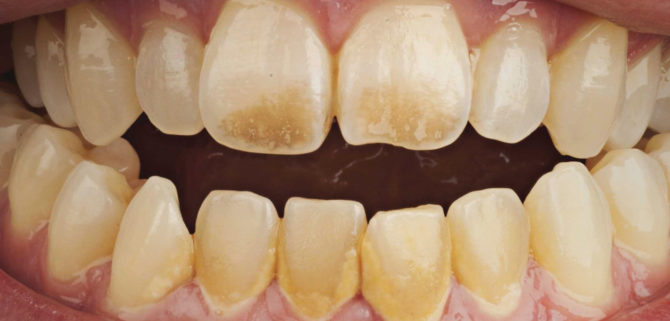 Teeth plaque