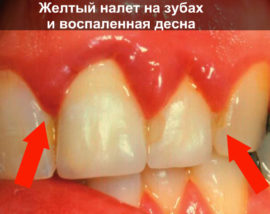 Plaque on the teeth and sore gums