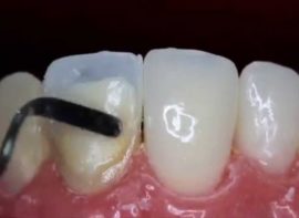 Application de matériau composite sur la dent