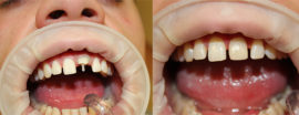 Extensia dinților la rădăcină