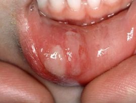 Stomatitis aphthous aphthous