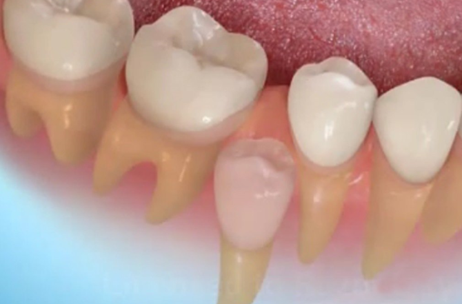 Crecimiento indebido permanente de los dientes con espacio insuficiente en la dentición.