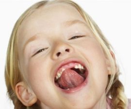 Freio normal na boca da criança