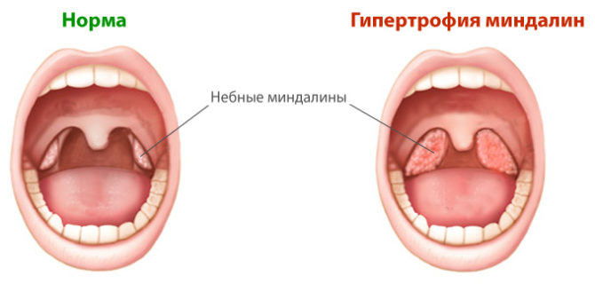 Mga normal na tonsil at pinalaki