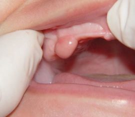 Zahnfleisch-Neubildung