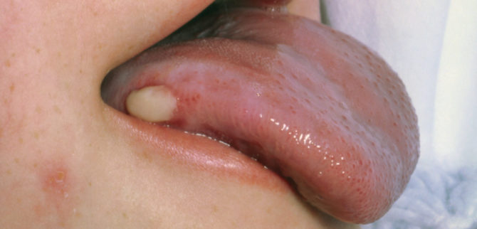 Tumeur dans la langue