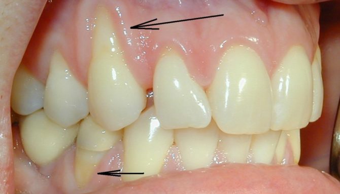 Racines de dents nues