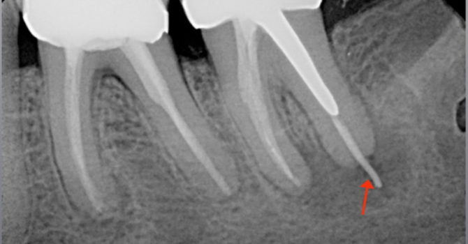 Exacerbation of chronic periodontitis under the stump tab