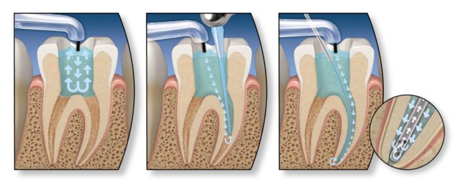 Tratamento do canal dentário