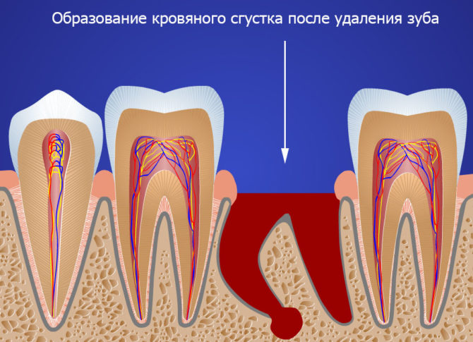 Tvorba krevní sraženiny po extrakci zubu