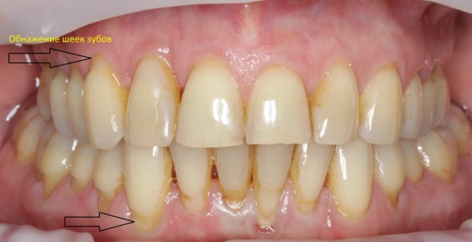 Goli cervikalni zubi