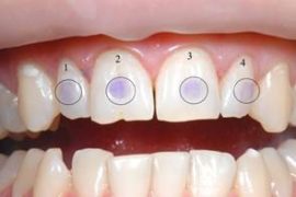 Coloration des dents pour identifier un point carieux