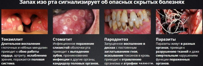 Gefährliche Ursachen für Mundgeruch