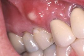 Zahnfleischtumor mit Parodontitis