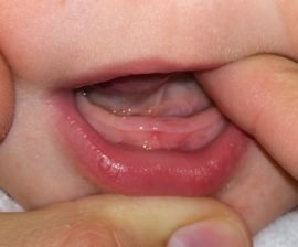 Gumă umflată înainte de dinți