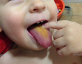 Lengua naranja en un niño