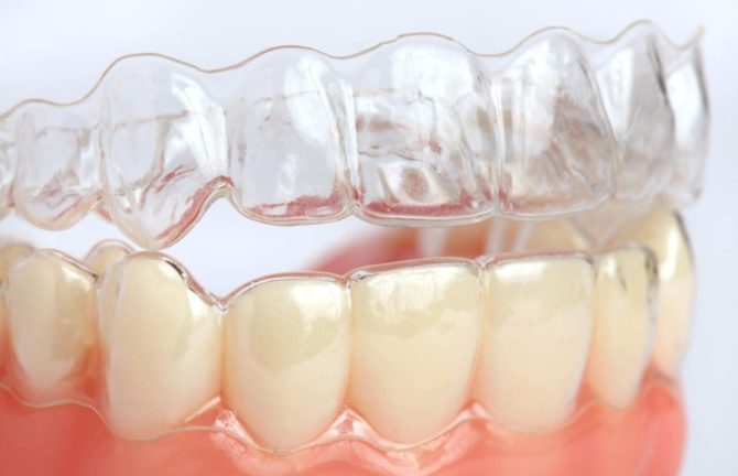 Ortodontisk munnstykke på tennene