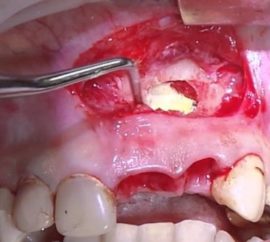 Complications after a fistula on the gum