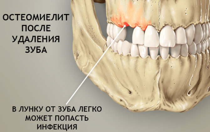 Osteomielite mandibular