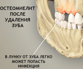 Osteomyelitis after tooth extraction