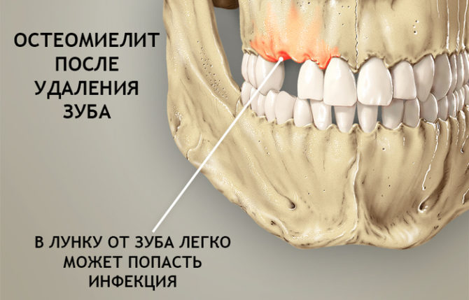 Osteomyelitida po extrakci zubu