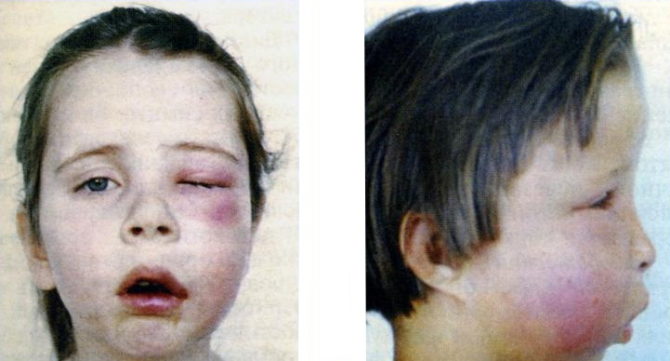 Acute odontogenic osteomyelitis in a child