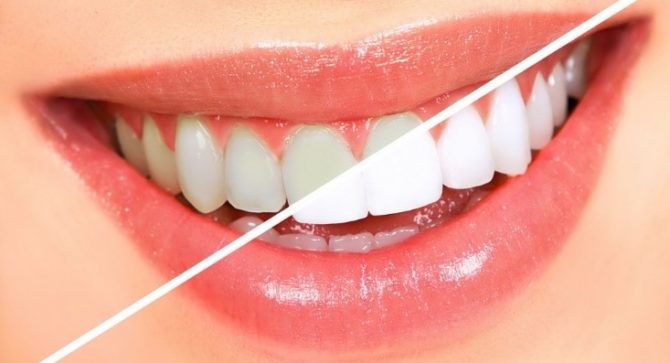 Blanchiment des dents - avant et après