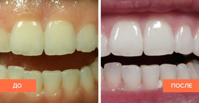 Làm trắng răng: Trước và sau khi hình ảnh