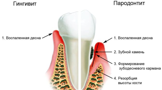 Différences entre la gingivite et la parodontite
