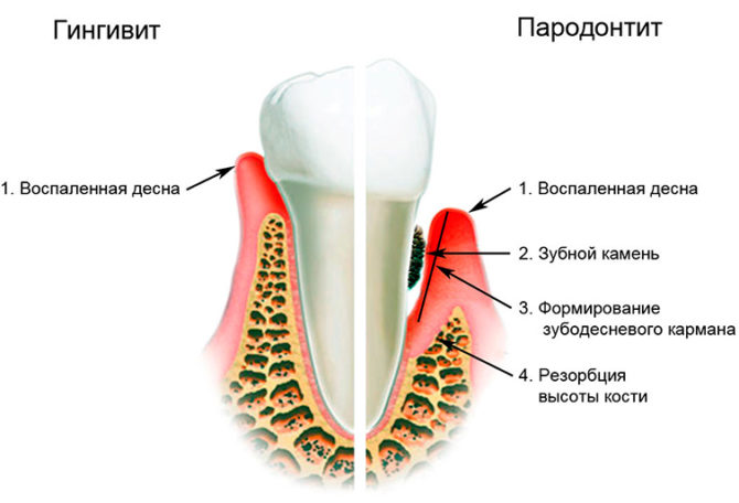 Differences in the symptoms of gingivitis and periodontitis