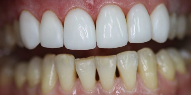 Denti restaurati della mascella superiore