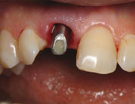 Rejet d'implant dentaire