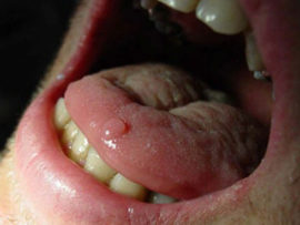 Papiloma da língua