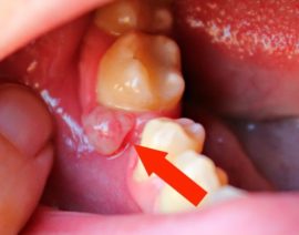 Abcès parodontal