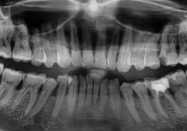 Parodontitída na obrázku