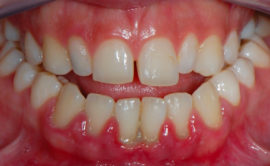 Nádor dásní periodontitidy