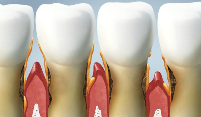 dinți parodontite