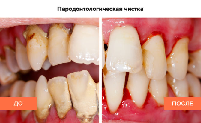 Periodontal cleaning of the periodontal pockets