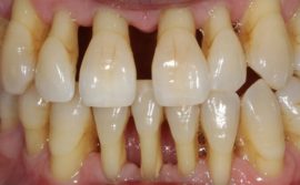 Penyakit periodontal