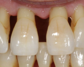 Doença periodontal