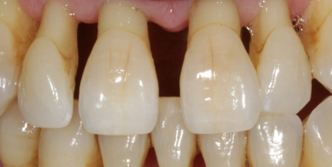 Enfermedad periodontal