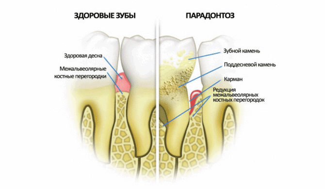 Boala parodontală schematic