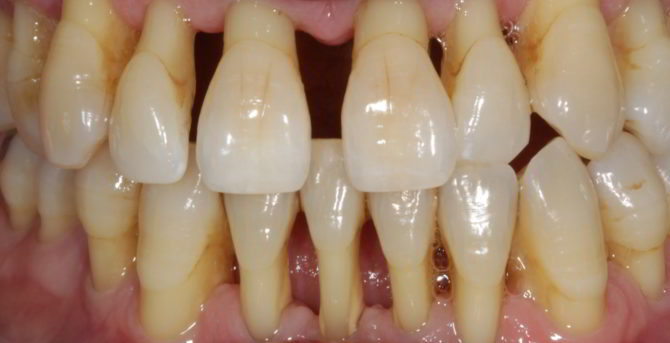 Periodontal tandvård