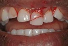 Zlomenina zubu