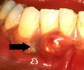 Parodontitida