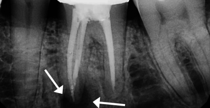 Periodontitis dalam x-ray