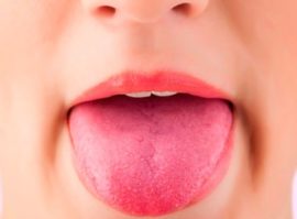 Första graden förbränning av tungan