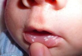 Sintomas primários de candidíase na boca de uma criança